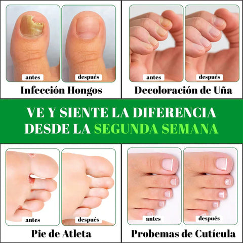 Image of GOTAS PARA LOS HONGOS EN LAS UÑAS